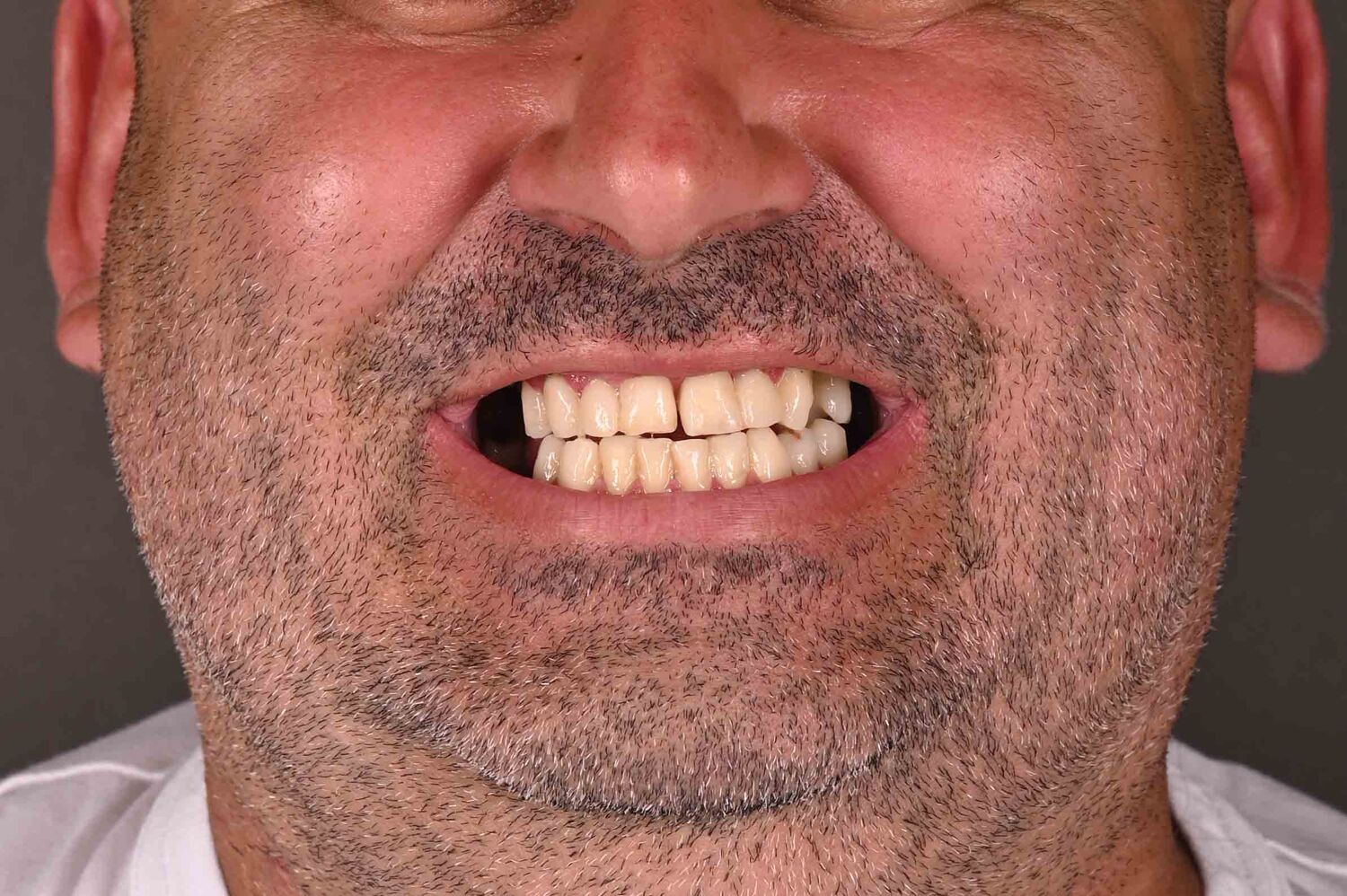 Pacient Clinica Dr. Alin Odor - Rezultat Implantologie
